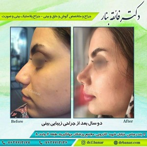 اقدامات قبل از جراحی بینی