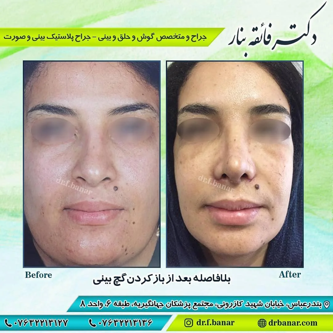 جراحی بینی 1