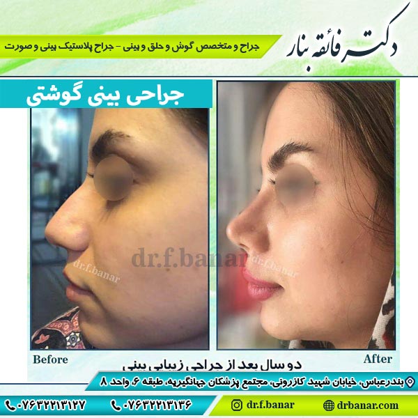 عکس قبل و بعد جراحی بینی گوشتی - دکتر فائقه بنار