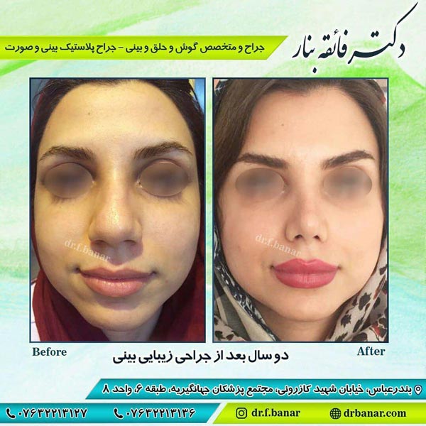 عکس قبل و بعد جراحی بینی گوشتی - دکتر فائقه بنار