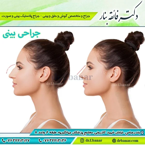 جراحی بینی