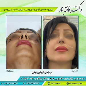 جراحی بینی فانتزی در بندرعباس - دکتر بنار