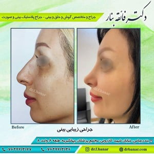 جراحی بینی فانتزی در بندرعباس - دکتر بنار
