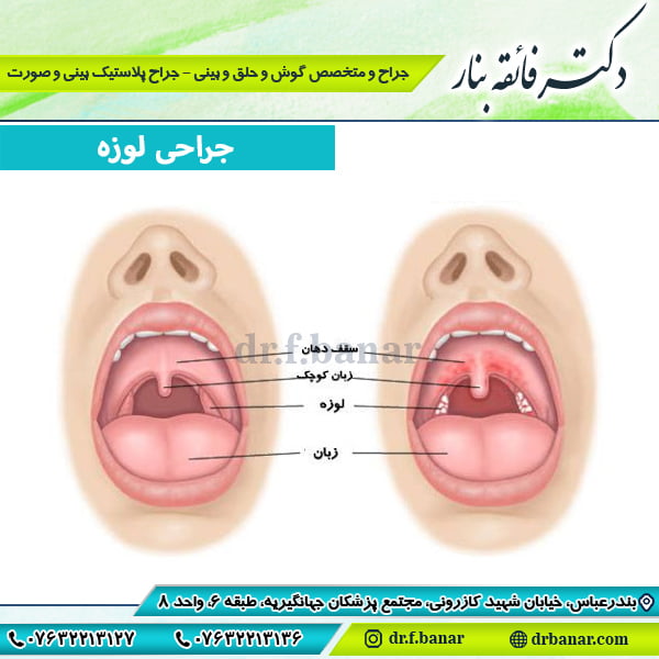 عکس جراحی لوزه