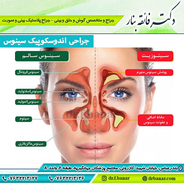 عکس جراحی اندوسکوپیک سینوس - دکتر فائقه بنار