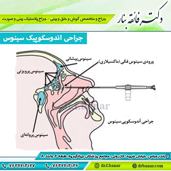 عکس جراحی اندوسکوپیک سینوس _ دکتر بنار