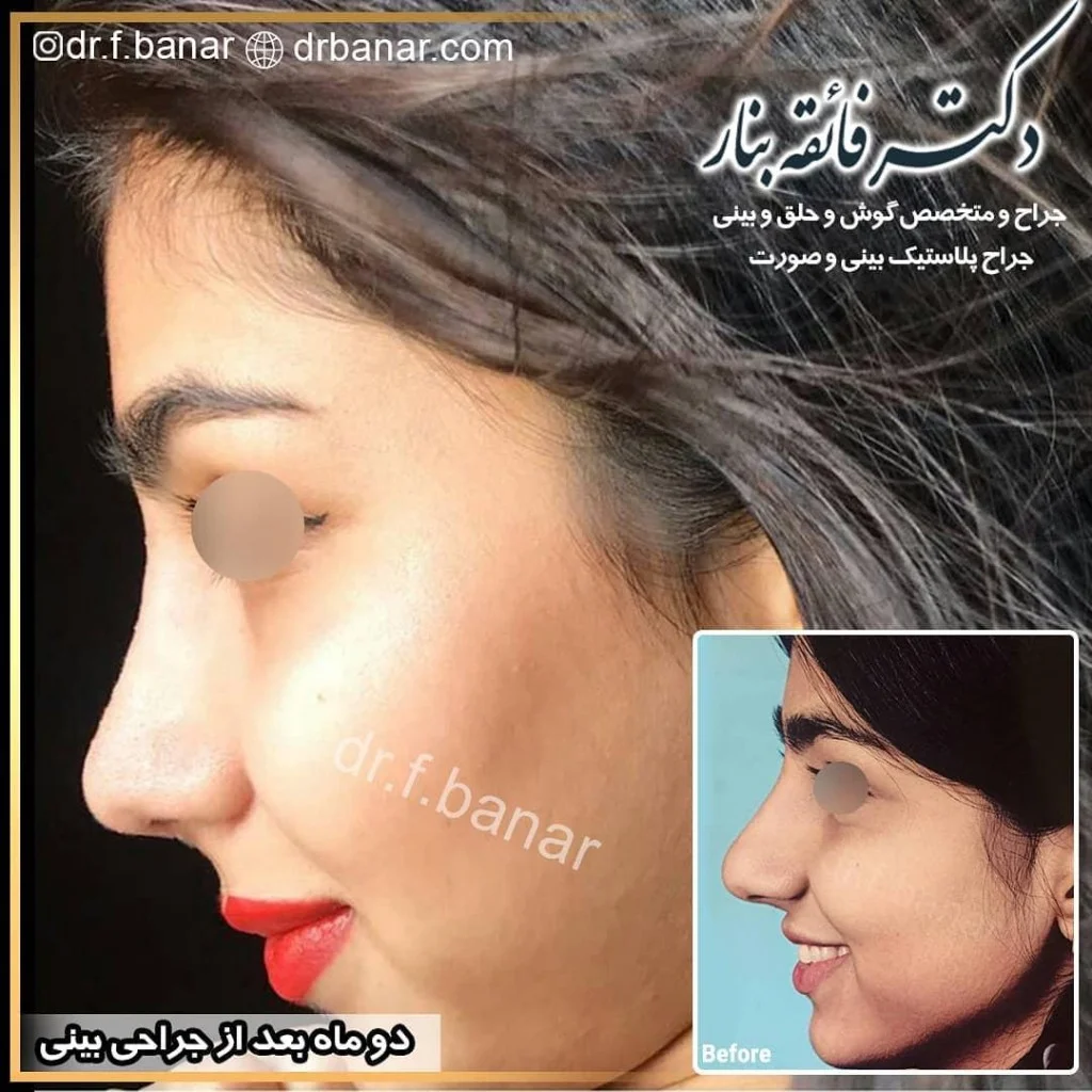 جراحی بینی نیمه فانتزی