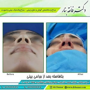 جراحی بینی نیمه فانتزی