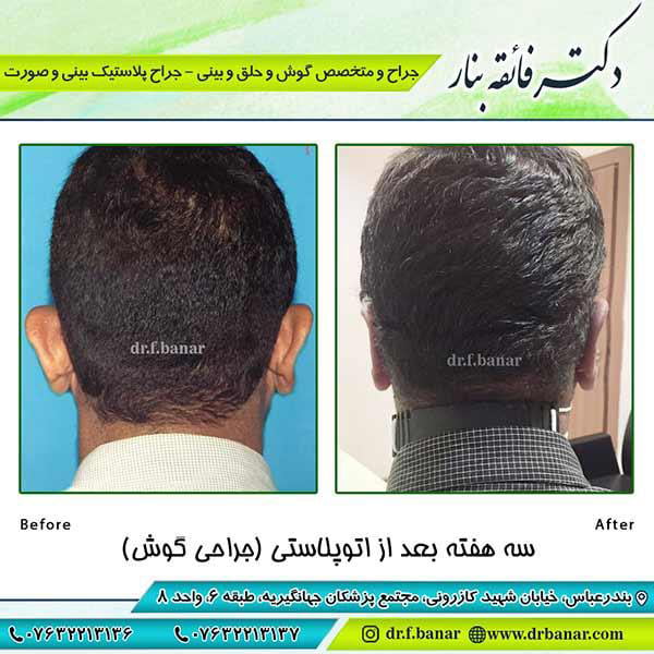 مراقبت های بعد از جراحی زیبایی گوش