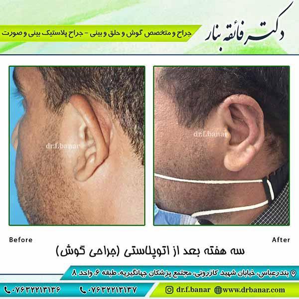 مراقبت های بعد از جراحی زیبایی گوش