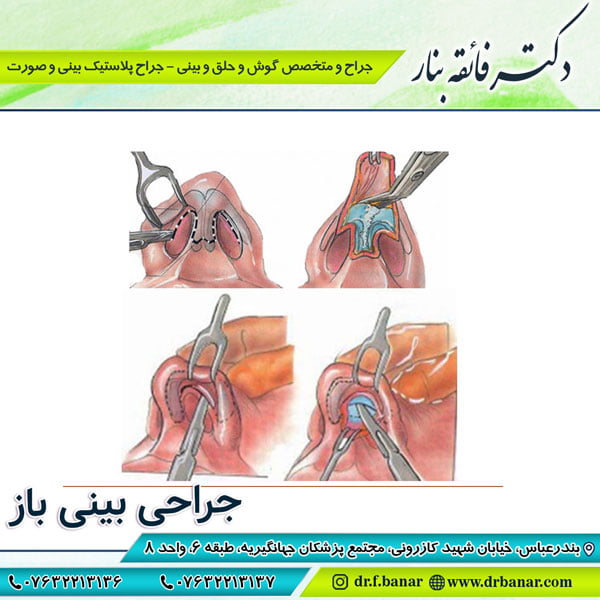 عکس جراحی بینی باز