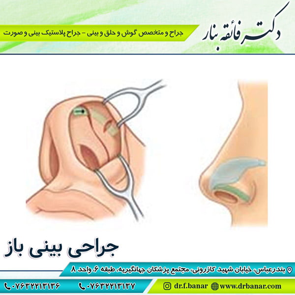 عکس جراحی بینی باز