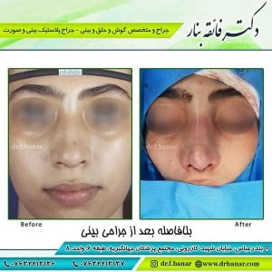 جراحی بینی کج