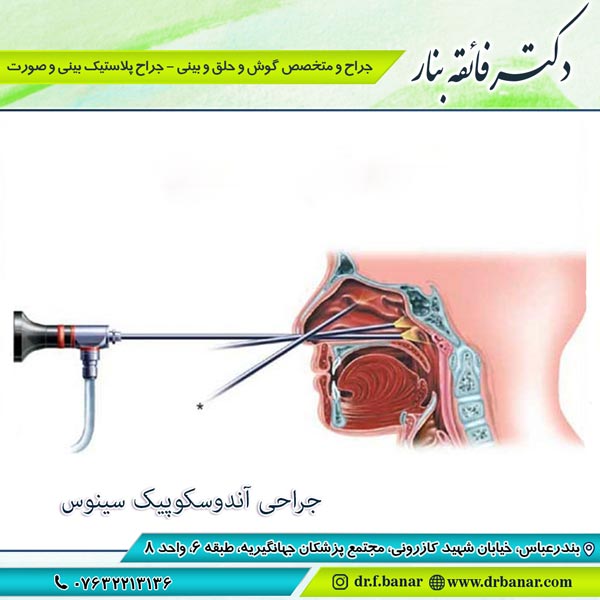 عکس جراحی آندوسکوپیک سینوس بندرعباس - دکتر فائقه بنار