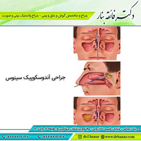 عکس جراحی آندوسکوپیک سینوس -بندرعباس