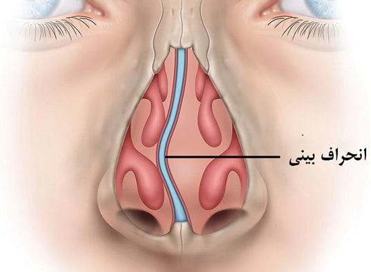 عکس انحراف بینی