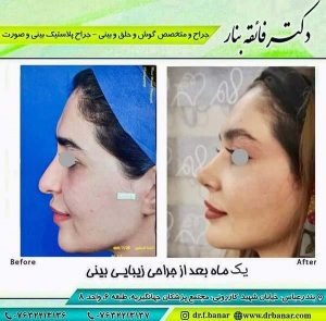 جراحی زیبایی بینی