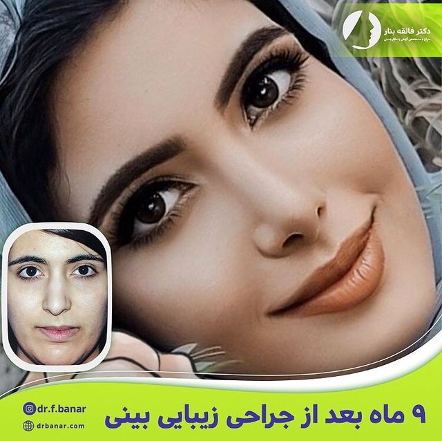 عکس قبل و بعد جراحی بینی