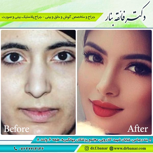 عکس قبل و بعد جراحی بینی