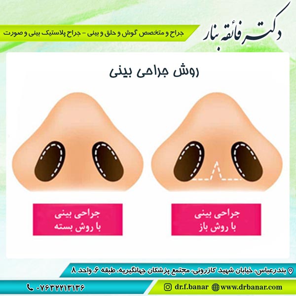 عکس روش جراحی بینی