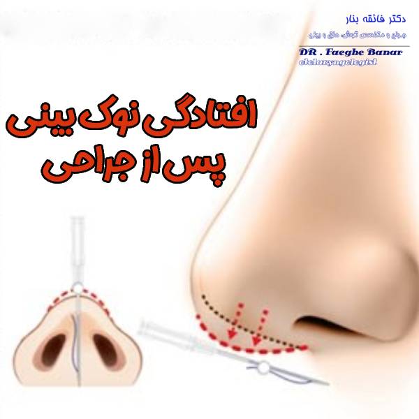 افتادگی نوک بینی بعد از جراحی - دکتر فائقه بنار