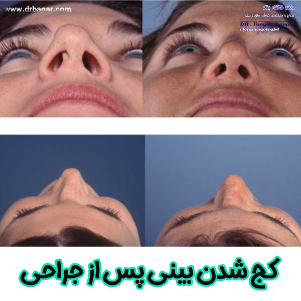 کج شدن بینی بعد از جراحی