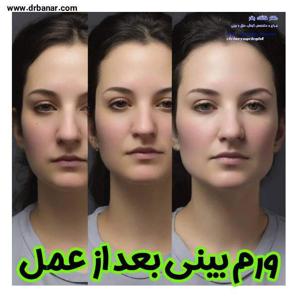 ورم بینی بعد عمل - دکتر فائقه بنار