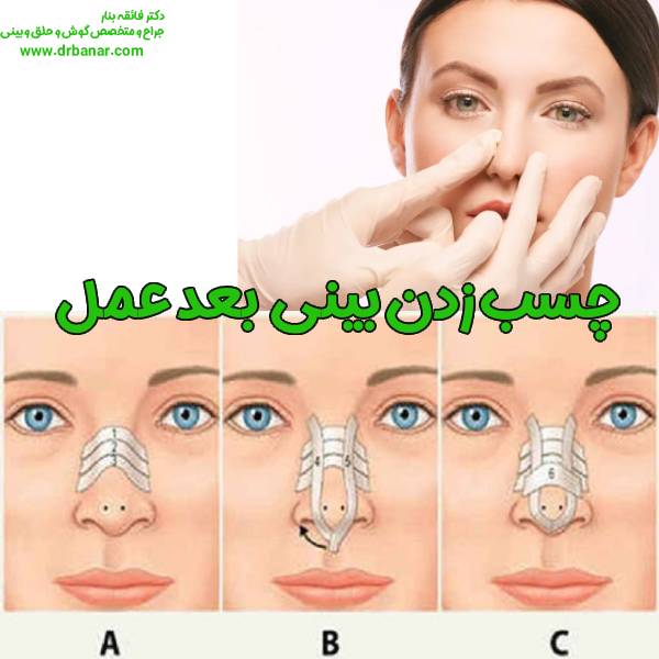 چسب زدن بینی بعد عمل - دکتر فائقه بنار