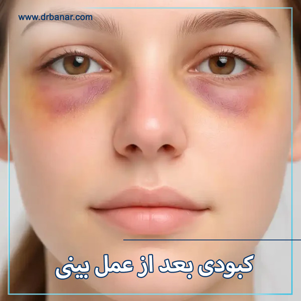 کبودی بعد از عمل بینی - دکتر فائقه بنار