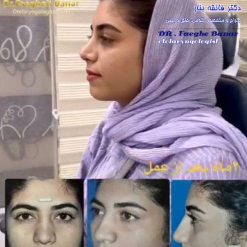 جراحی-بینی-در-بندرعباس-250