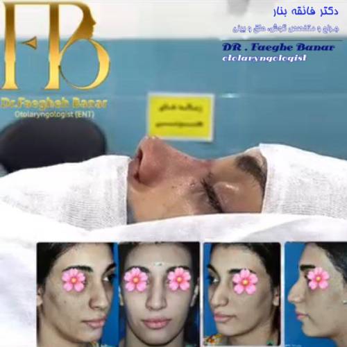 جراحی-بینی-در-بندرعباس-253