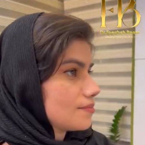 New-جراحی-بینی-در-بندرعباس-258