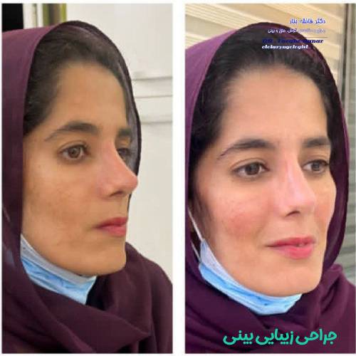 جراحی-بینی-در-بندرعباس-254