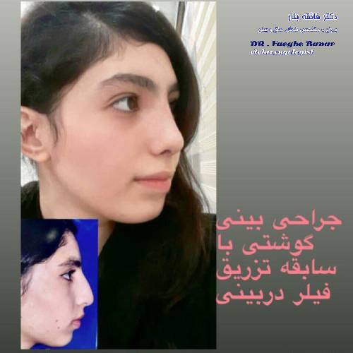 جراحی-بینی-در-بندرعباس-257