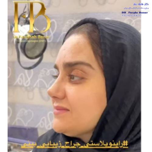 جراحی-بینی-در-بندرعباس-255