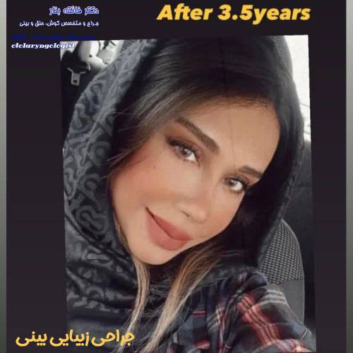 جراحی-بینی-در-بندرعباس-255