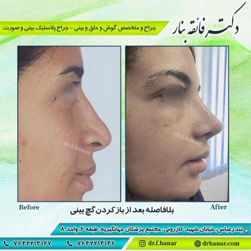 جراحی بینی