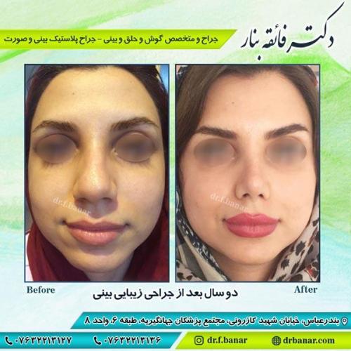 جراحی بینی
