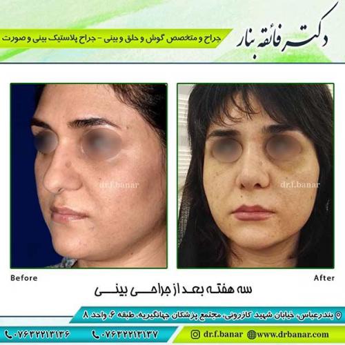 جراحی-بینی-100
