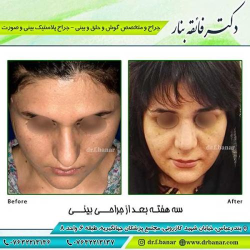 جراحی-بینی-101