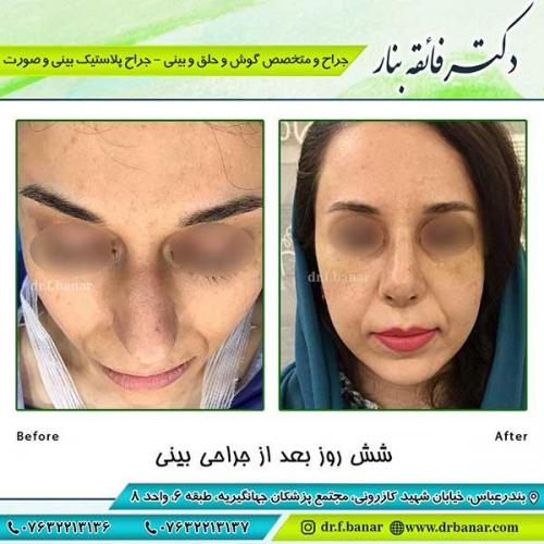 جراحی-بینی-108