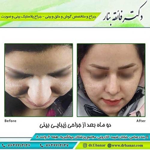 جراحی-بینی-109