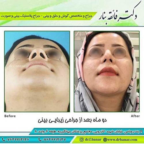 جراحی-بینی-110