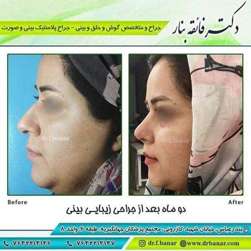 جراحی-بینی-111