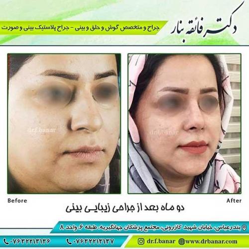 جراحی-بینی-113