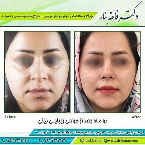 جراحی-بینی-114