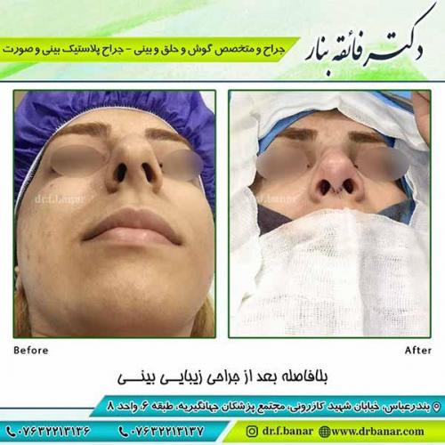 جراحی-بینی-115