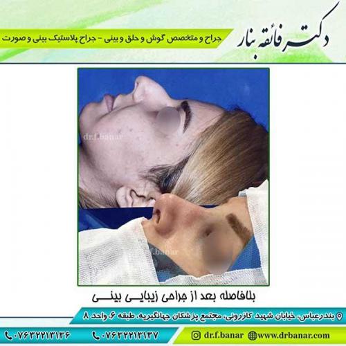 جراحی-بینی-118