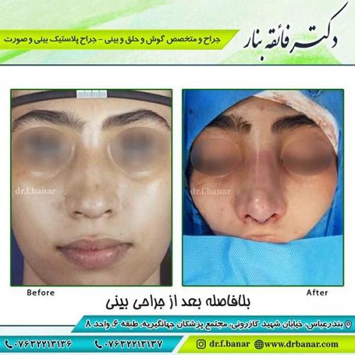 جراحی-بینی-55