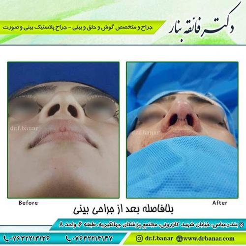 جراحی-بینی-56
